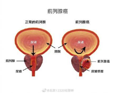 什么时候需要做前列腺磁共振检查？ (图1)