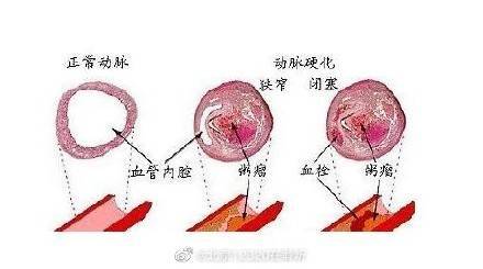 动脉硬化有哪些症状？ (图1)