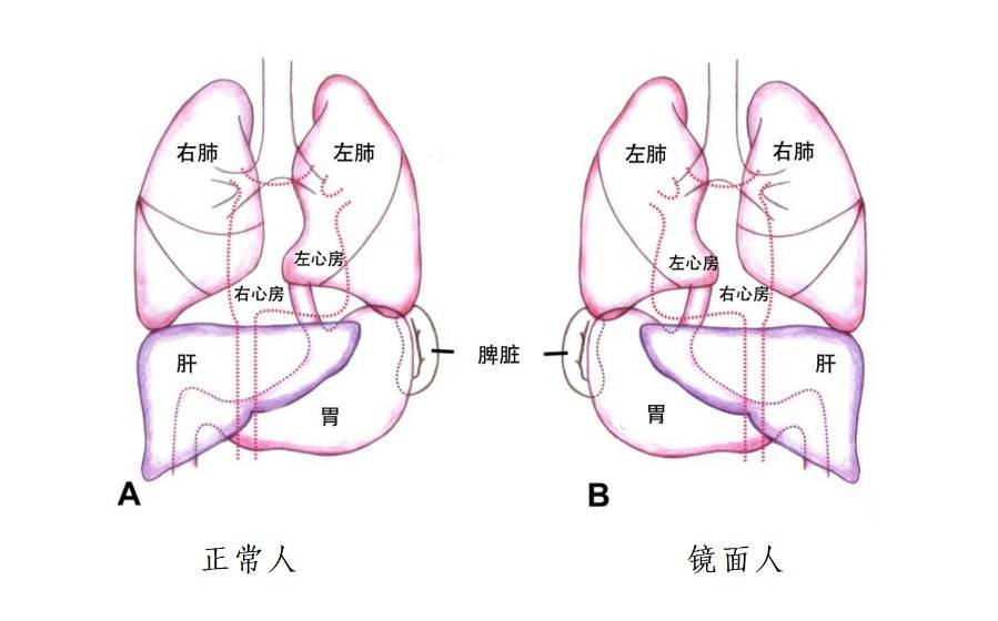 五脏六腑反着长！海南一女子的手术要“反向做”→ (图1)