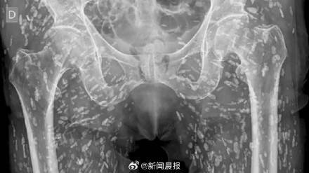 男子吃没熟猪肉下半身遍布绦虫卵，医生：见过最疯狂的X光片之一 (图1)