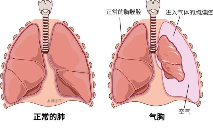 一口气做20个俯卧撑后，男子的肺“炸”了……咋回事？ (图1)