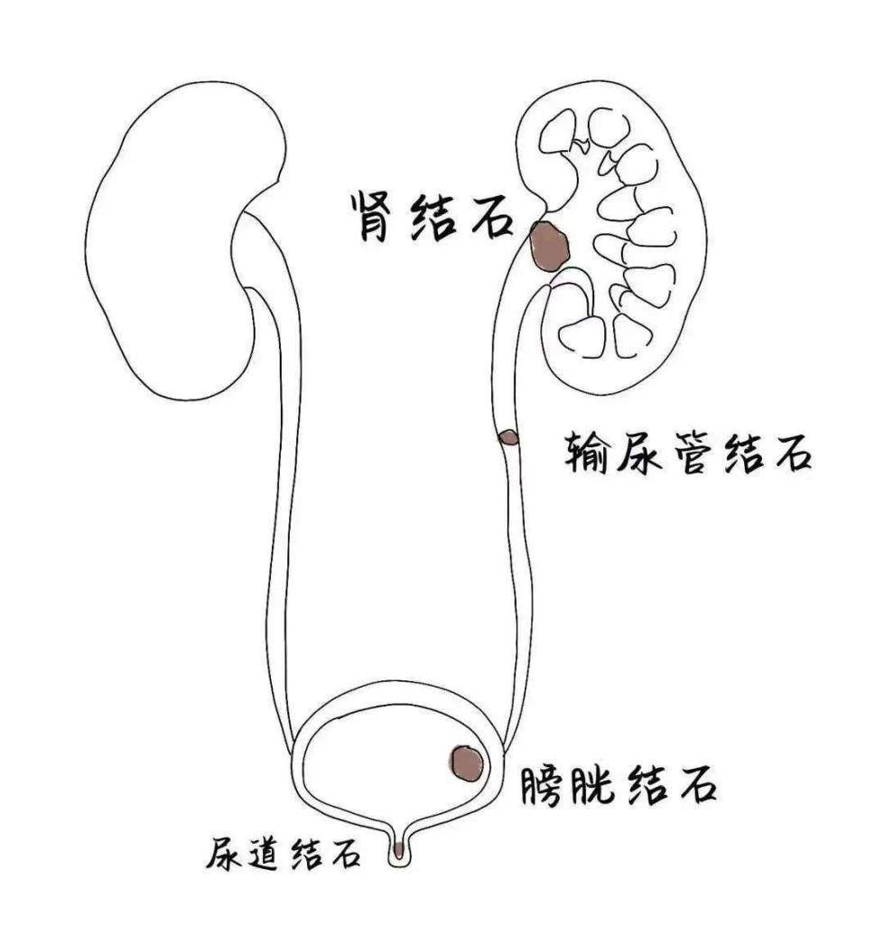 为什么女性更易患尿路感染？如何预防? (图3)