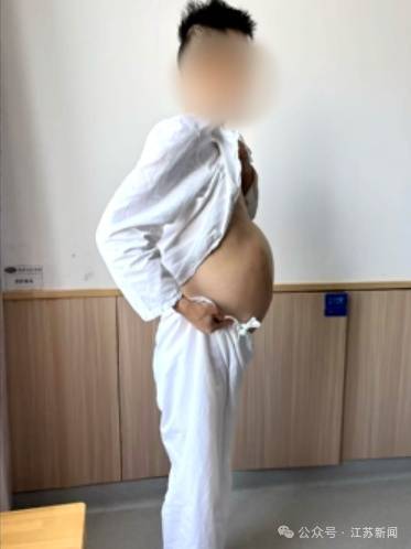 男子4个月没排便,腹中掏出20多斤、2米长“巨蟒”结肠 (pic1) 男子4个月没排便,腹中掏出20多斤、2米长“巨蟒”结肠 (pic1)