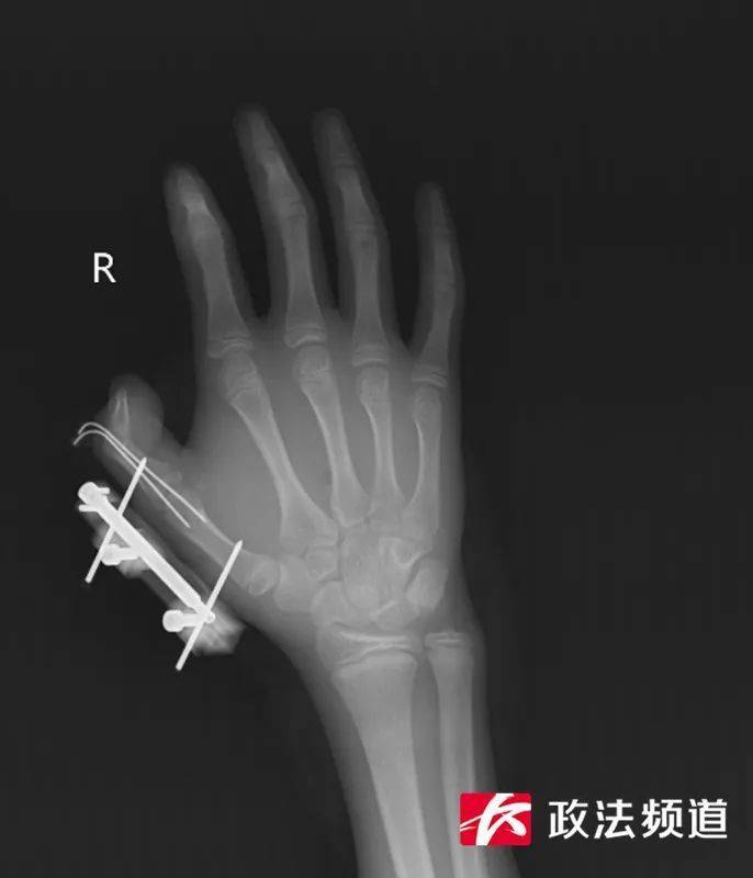 14岁少年被“冰”炸伤手指?专家提醒:干冰不能玩! (pic2) 14岁少年被“冰”炸伤手指?专家提醒:干冰不能玩! (pic2)