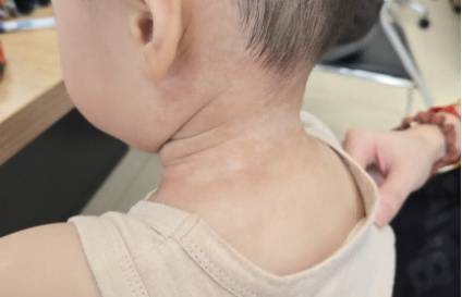 浙江一对母子相继患“怪病”，红斑爬满全身痒得无法睡觉！元凶是它，很多人家里在用… (pic2)