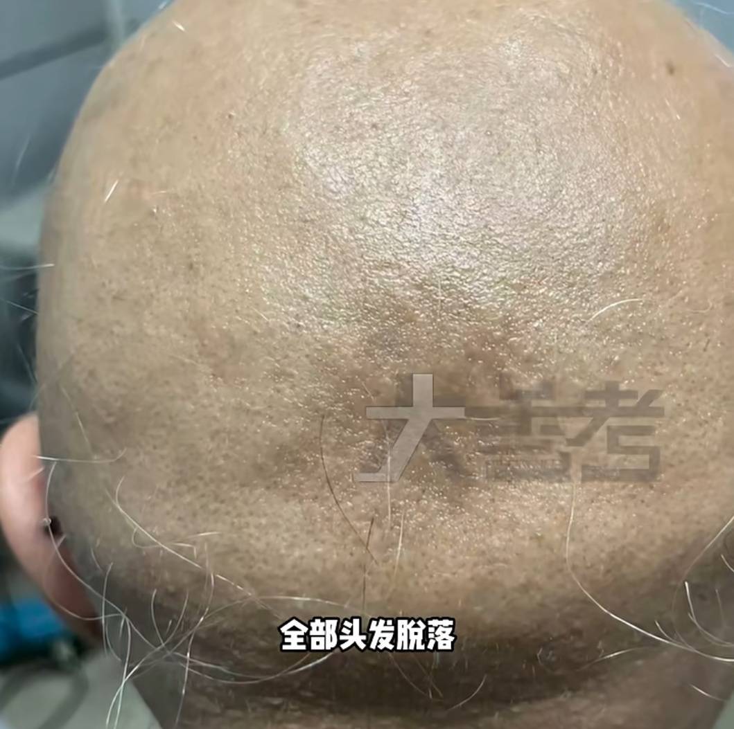 20岁女孩失恋一个月，毛发突然全部脱落！医生提醒→ (pic1)