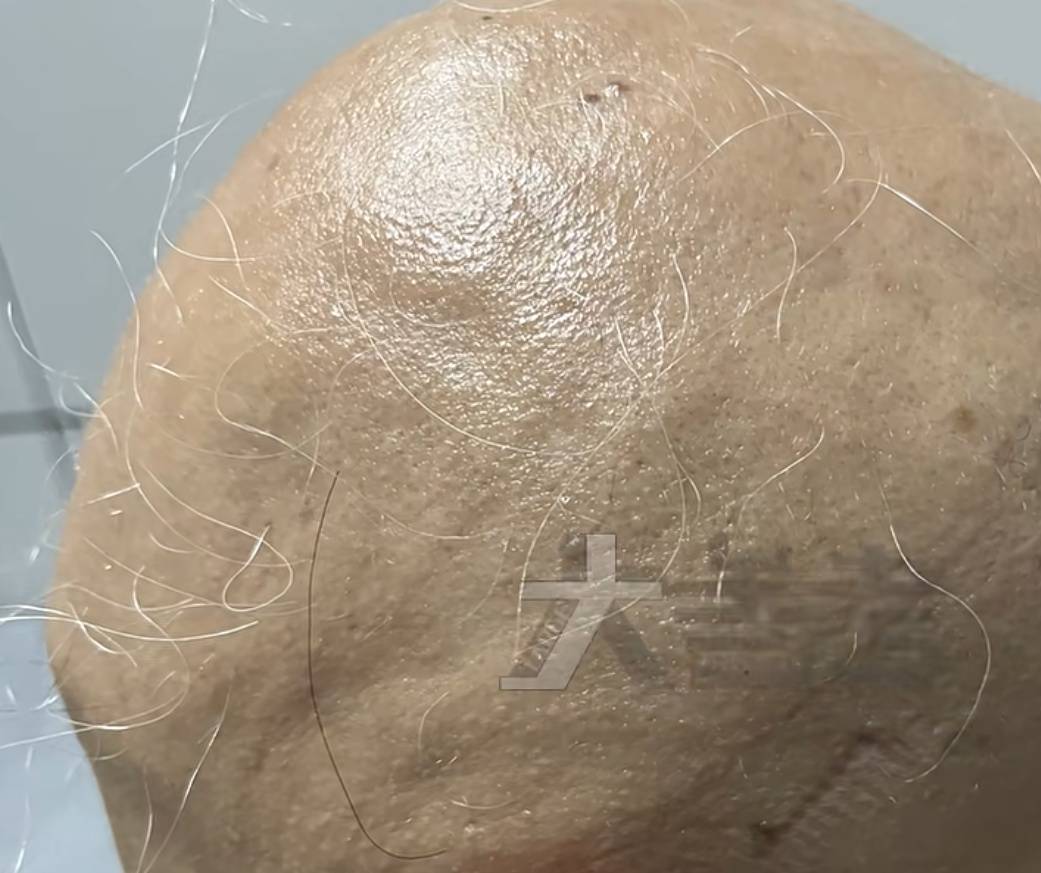 20岁女孩失恋一个月，毛发突然全部脱落！医生提醒→ (pic2)