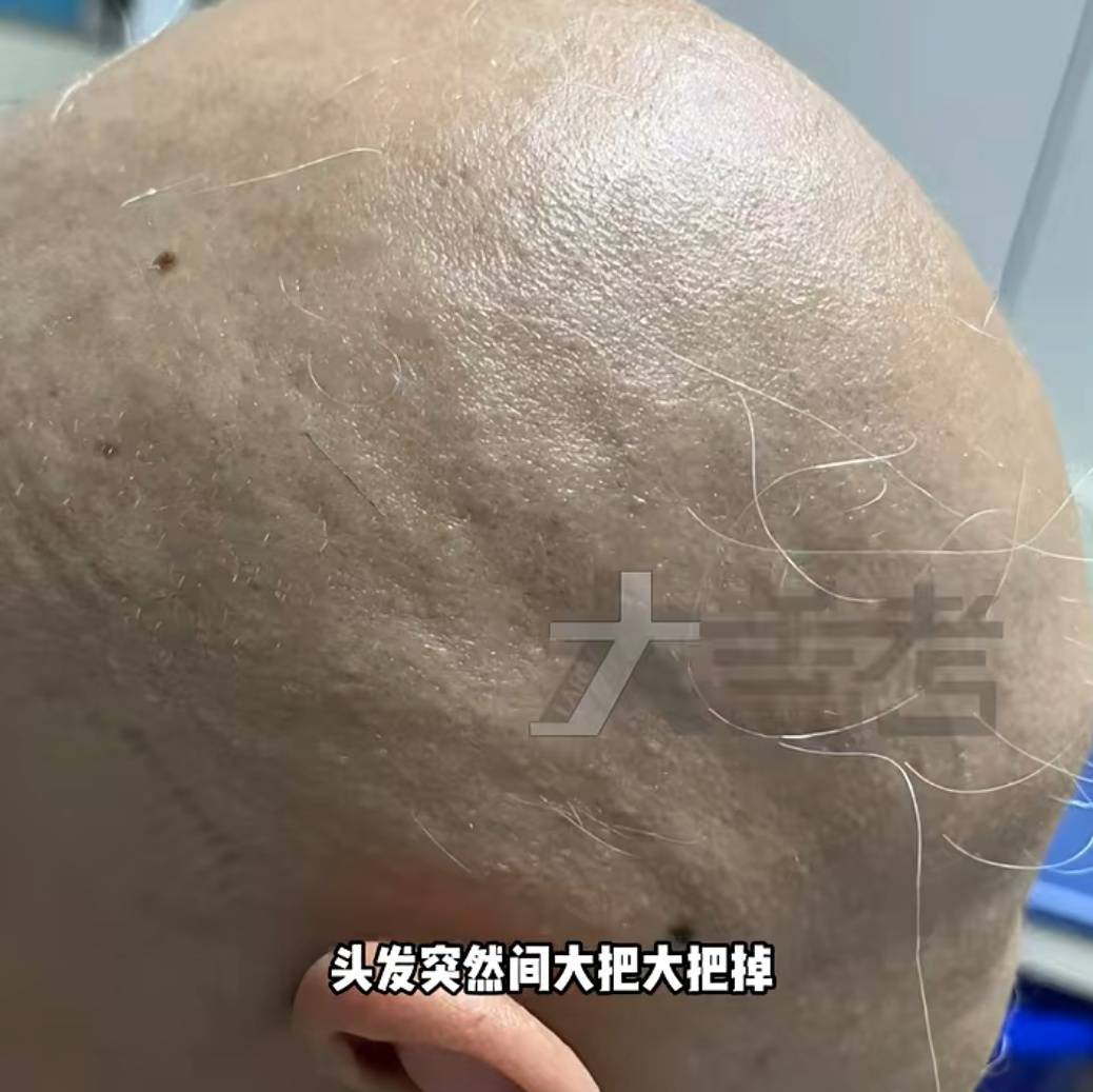20岁女孩失恋一个月，毛发突然全部脱落！医生提醒→ (pic3)