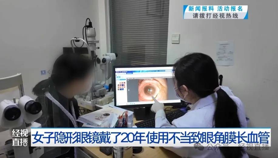 女子戴隐形眼镜20年,角膜长出3毫米新生血管!医生提醒:隔夜佩戴隐形眼镜的风险极高 (pic1) 女子戴隐形眼镜20年,角膜长出3毫米新生血管!医生提醒:隔夜佩戴隐形眼镜的风险极高 (pic1)