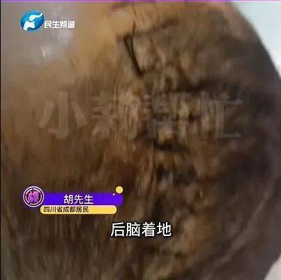 女子睡前没摘发饰,夜里插入耳朵直抵后脑勺!医生:绝非个例! (pic2) 女子睡前没摘发饰,夜里插入耳朵直抵后脑勺!医生:绝非个例! (pic2)