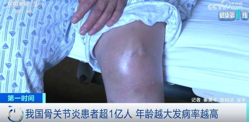 超1亿人患病!以为关节炎只是老年病?这些因素正让它悄悄盯上年轻人 (pic1) 超1亿人患病!以为关节炎只是老年病?这些因素正让它悄悄盯上年轻人 (pic1)
