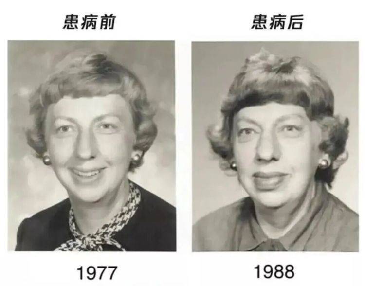 出现这种面相,可能是肿瘤前兆!别以为只是“发福”了 (pic1) 出现这种面相,可能是肿瘤前兆!别以为只是“发福”了 (pic1)