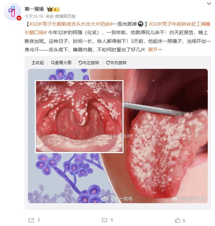 深圳一男子熬夜加班，舌头长出大片“奶皮”，一抠“奶皮”肉就掉 (pic1)