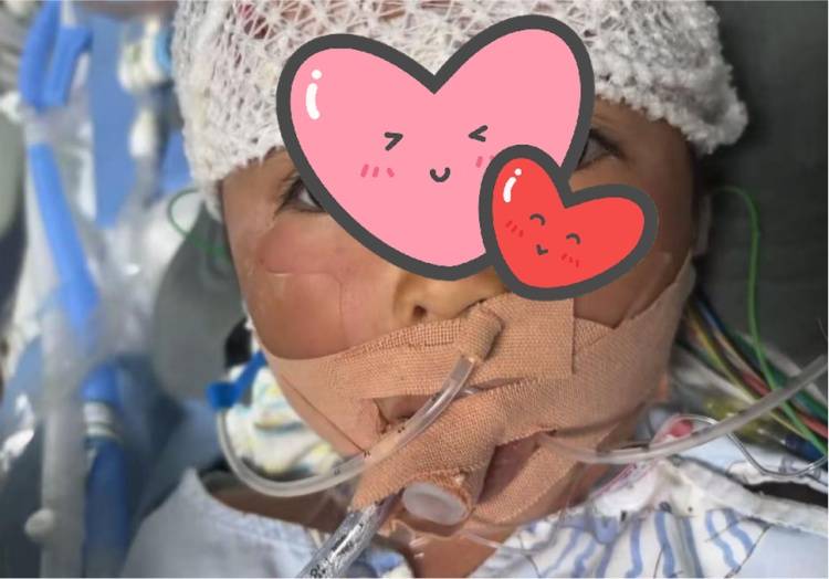 3岁女童在家中被毒蛇咬伤,“假死”3天奇迹生还 (pic4) 3岁女童在家中被毒蛇咬伤,“假死”3天奇迹生还 (pic4)