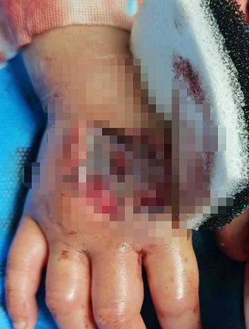 3岁女童在家中被毒蛇咬伤,“假死”3天奇迹生还 (pic3) 3岁女童在家中被毒蛇咬伤,“假死”3天奇迹生还 (pic3)