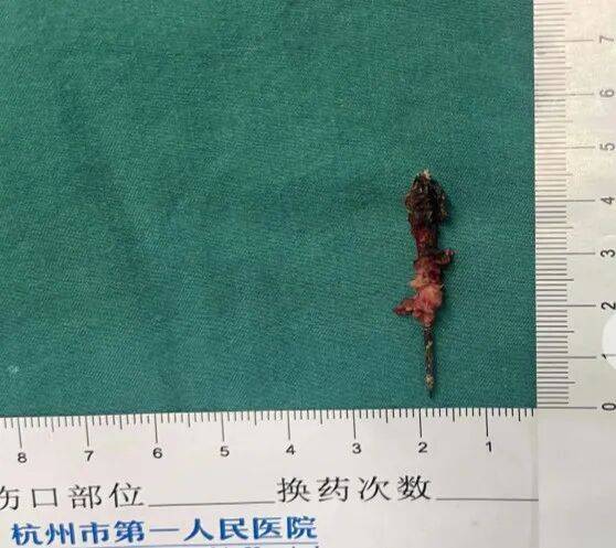 17岁小伙参军体检,发现胸腔内有根5cm缝衣针 (pic3) 17岁小伙参军体检,发现胸腔内有根5cm缝衣针 (pic3)