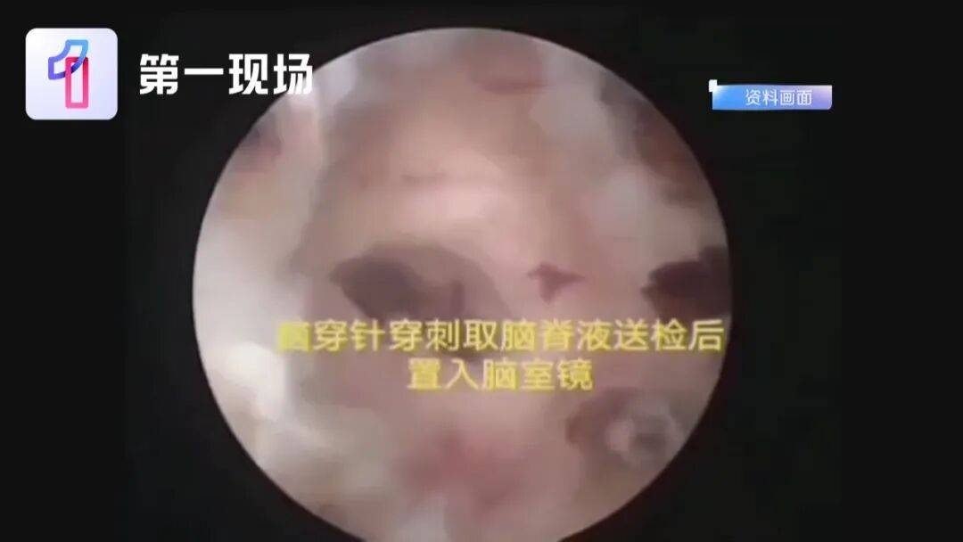 23岁女孩头痛，硬扛7天后心脏停跳，ICU里开颅3次，仍昏迷未醒！元凶几乎家家都有 (pic2)