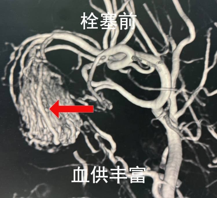 17岁少年鼻塞3年,反复流鼻血,医生一查:不是鼻炎,是肿瘤! (pic2) 17岁少年鼻塞3年,反复流鼻血,医生一查:不是鼻炎,是肿瘤! (pic2)