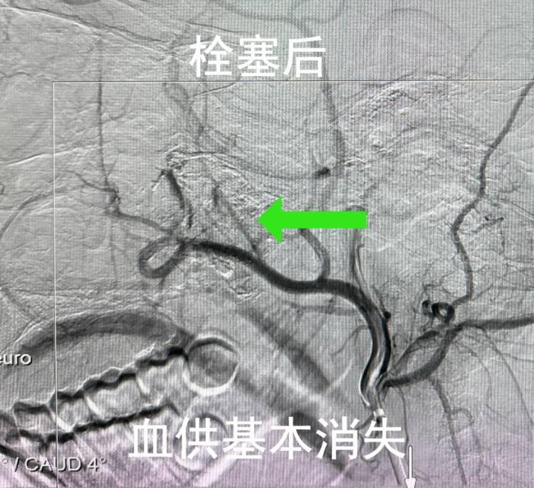 17岁少年鼻塞3年,反复流鼻血,医生一查:不是鼻炎,是肿瘤! (pic3) 17岁少年鼻塞3年,反复流鼻血,医生一查:不是鼻炎,是肿瘤! (pic3)