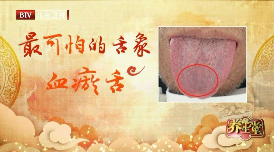 心血管不好的人,舌头会有这种变化!每天一杯羹,化瘀血、护心脏 (pic2) 心血管不好的人,舌头会有这种变化!每天一杯羹,化瘀血、护心脏 (pic2)