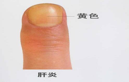 男子手指甲发紫妻子劝他去医院被怼“吃饱了没事干”,几天后老公突然胸痛被120拉走 (pic4) 男子手指甲发紫妻子劝他去医院被怼“吃饱了没事干”,几天后老公突然胸痛被120拉走 (pic4)