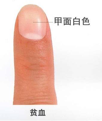 男子手指甲发紫妻子劝他去医院被怼“吃饱了没事干”,几天后老公突然胸痛被120拉走 (pic2) 男子手指甲发紫妻子劝他去医院被怼“吃饱了没事干”,几天后老公突然胸痛被120拉走 (pic2)