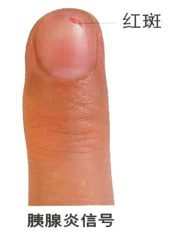 男子手指甲发紫妻子劝他去医院被怼“吃饱了没事干”,几天后老公突然胸痛被120拉走 (pic3) 男子手指甲发紫妻子劝他去医院被怼“吃饱了没事干”,几天后老公突然胸痛被120拉走 (pic3)