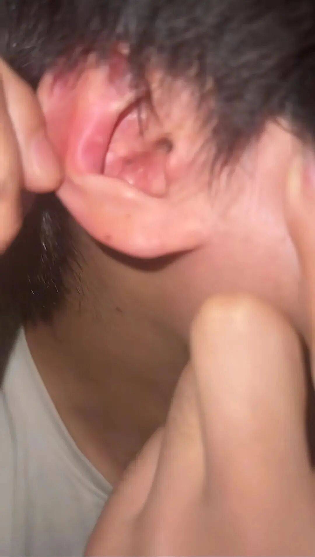 大学生戴耳机入睡,耳机在耳朵里爆炸:非“杂牌”,此前未出现异常 (pic2) 大学生戴耳机入睡,耳机在耳朵里爆炸:非“杂牌”,此前未出现异常 (pic2)