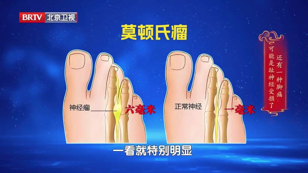 走路多了脚疼不正常?医生:这种疼可能是神经在报警,两个小妙招,轻松护足 (pic15) 走路多了脚疼不正常?医生:这种疼可能是神经在报警,两个小妙招,轻松护足 (pic15)