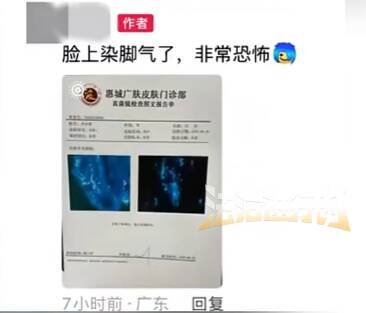 男子健身后脸上长“脚气”,直呼太恐怖!只因健身时没戴手套也没消毒 (pic1) 男子健身后脸上长“脚气”,直呼太恐怖!只因健身时没戴手套也没消毒 (pic1)