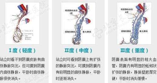 备孕两年无果,28岁杭州男子傻眼:这里竟藏了一窝“蚯蚓”!医生:千万别小看了 (pic1) 备孕两年无果,28岁杭州男子傻眼:这里竟藏了一窝“蚯蚓”!医生:千万别小看了 (pic1)